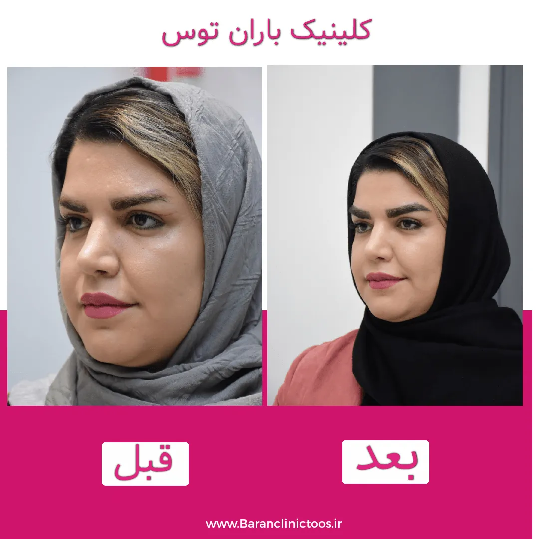 قبل و بعد کاشت ابرو